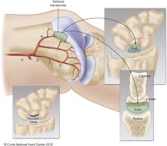 This adaptable graft option is most commonly used with oats or shell techniques to restore cartilage in the knee, but can also be used to for cartilage restoration of other joints. Vascularized Medial Femoral Trochlea Osteochondral Flap Reconstruction Of Advanced Kienbock Disease Journal Of Hand Surgery