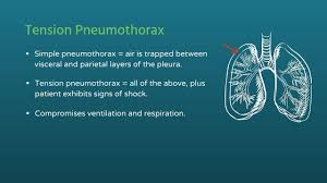 Image result for Open Pneumothorax
