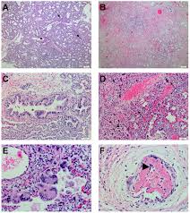 According to who, the nipah virus infection is a newly emerging zoonosis, that is, a disease transmitted from animals to humans. Histopathological Changes During Nipah Virus Infection In Human Lung Download Scientific Diagram