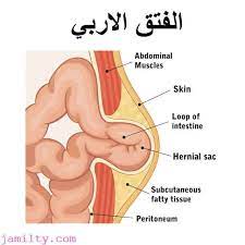 الفتق الاربي أعراضه وأسبابه وطرق علاج الفتق المختلفة عند البنات والأطفال الرضع جميلتي