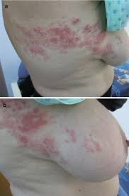 Image result for zoster under breasts