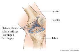 If your insurance plan covers it, your doctor will if you don't have insurance and will be paying for your knee replacement, it's wise to research knee replacement costs. Knee Replacement Surgery Cigna