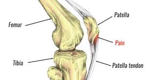 Ligaments are tough bands of tissue that connect the ends of bones together. Patellar Tendonitis Jumper S Knee Symptoms Causes And Treatment