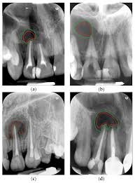 Image result for granuloma gum disease
