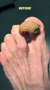 Image result for Onychogryphosis feet