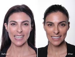 Before & After Gallery