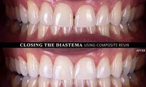 The first step in tooth bonding will be to roughen the gap area so that the bonding material will adequately stick to it. Dental Bonding Conservative Yet Effective Cosmetic Solution In Just One Appointment