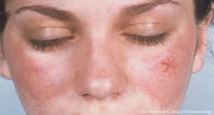 Lupus Treatments: Into the Future