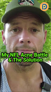 Football Chinstrap Acne