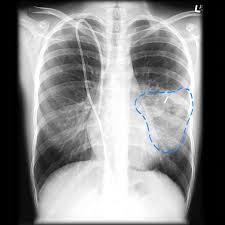 Aspergillosis occurs in chronic or acute forms which are clinically very distinct. Angioinvasive Aspergillosis Radiology Case Radiopaedia Org