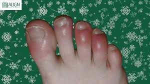 Image result for Chilblains