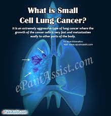Last stage of lung cancer symptoms related to brain metastases may include seizures, headaches, speech problems, weakness and other neurological symptoms. Small Cell Lung Cancer Causes Symptoms Treatment Staging Recovery Survival Rate Risk Factors