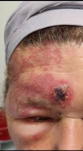 Image result for herpes zoster