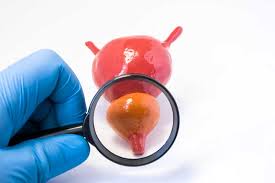 There are a number of different treatments doctors recommend. How Do You Know If You Have A Prostate Cancer