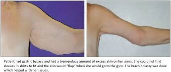 Pin On Plastic Surgery After Wls