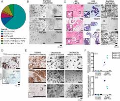 Most people with pancreatic cancer (and nearly all people with ampullary cancer) will have jaundice as one of their first symptoms. Pancreatic Cancer Organoids Recapitulate Disease And Allow Personalized Drug Screening Pnas