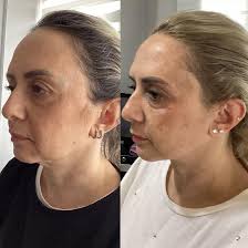 Orjinal Alman Adela Cross Fethiye de sadece Pınar Pınar estetik ve sağlıklı  yaşam merkezinde📣📣📣📣 ••••••••••••••••••••••••••••••••••••••• ❄️Buz  başlık ile AĞRISIZ ACISIZ epilasyon keyfi ———————————————— ✓ Maksimum 4  SEANS ile 6 SEANS arası ...