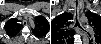 Image result for Relapsing Polychondritis