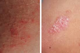 Image result for psoriasis