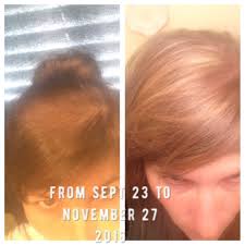 Hair Restoration With Diatomaceous Earth Beef Gelatin And Protein Powder 1 Tbs Each Daily In Green Drink Help Hair Loss Hair Restoration Beef Gelatin