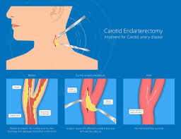 Image result for carotid artery