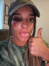 Horse riding injury to orbital and leg