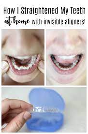 Why I Decided To Straighten My Teeth With Smiledirectclub At Home Braces System Invisible Aligners And How I Invisalign Teeth Straightening Smiledirectclub