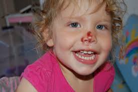 So… yeah. Here's a post about bruises and cuts.