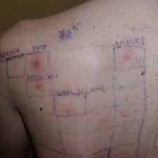 Tattoo inks are deposited deep in the dermis, below the epidermis (the layer of skin affected by eczema), so generally they will not be damaged by itchiness. Pdf Henna Tattoo Contact Dermatitis A Report Of Four Cases And Brief Review Of The Selected Literature