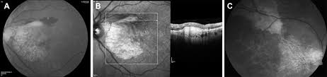 Amd (nasdaq:amd) and intel (nasdaq:intc) both manufacture and market microprocessors used in servers, desktop pcs, and notebooks. Safety And Efficacy Of Subretinally Administered Palucorcel For Geographic Atrophy Of Age Related Macular Degeneration Ophthalmology Retina