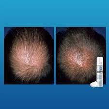 Find out what the resea. Rogaine Foam For Men 5 Minoxidil Treatment For Hair Loss Cvs Pharmacy