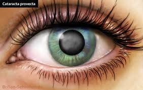 Zaćma podtorebkowa tylna (cataracta subcapsularis posterioris, ang. Cataracta Provecta Fortgeschrittener Grauer Star