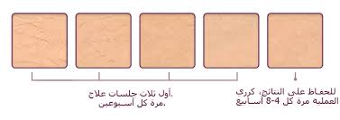 جدول جلسات العلاج home laser hair removal laser hair removal laser hair