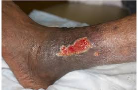 Image result for Stasis Dermatitis