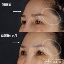 ジュベルックボリューム症例 | Drはるなの美容のあれこれ♡
