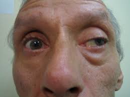 Image result for Pupillary Paralysis
