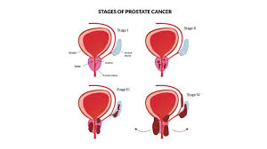 Image result for Prostate Cancer Staging