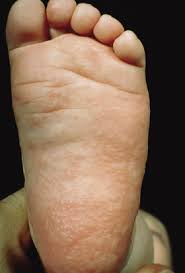 Image result for pompholyx soles of feet