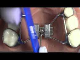 How To Turn Your Expander Palate Expander Dentistry Orthodontist