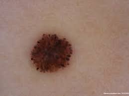 Image result for Spitz Nevus