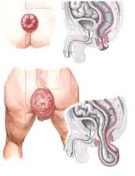 If you think you have rectal prolapse, your doctor prognosis of rectal prolapse. 19 Ayurvedic Ideas Rectal Prolapse Rectal Ayurvedic