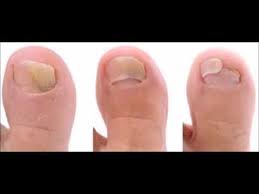 When fungus infects the areas between your toes and the skin of your feet, it's. How Long Does It Take For Apple Cider Vinegar To Cure Toenail Fungus Youtube