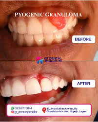 Image result for granuloma gum disease