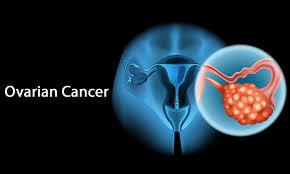 The early warning signs of ovarian cancer are often extremely subtle, which is why most women aren't diagnosed until the disease has advanced to stage iii or iv. Ovarian Cancer Symptoms Causes Prevention Sachin Marda Best Cancer Specialist In Hyderabad