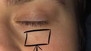 Get detailed information about breast cancer risks, causes, symptoms, treatments, research, and more. The Spot Under This Woman S Eye Looked Like A Pimple But It Was Skin Cancer Health Com