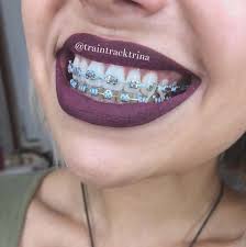 Image May Contain One Or More People And Closeup Cute Braces Colors Braces Tips Dental Braces