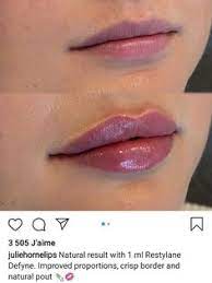 How to get the best lips with lip filler? 97 Lip Injections Juvederm Ideas Lip Injections Lip Injections Juvederm Lip Fillers