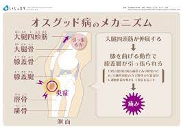 オスグッド病のメカニズム infographics 医療 解剖学 生理学