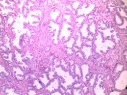 The apex of the prostate, 2. Well Differentiated Prostate Cancer Prepared Slides Of Human Pathology Xinxiang Happy Science Co Ltd