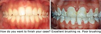 Once threaded, gently floss up and down between your gums on each side. How To Brush Your Teeth With Braces Ismile Specialists